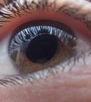 Glaucome et cataracte: quelles différences?