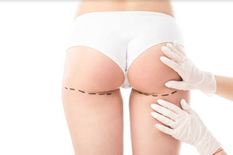 lipofiling fessse
