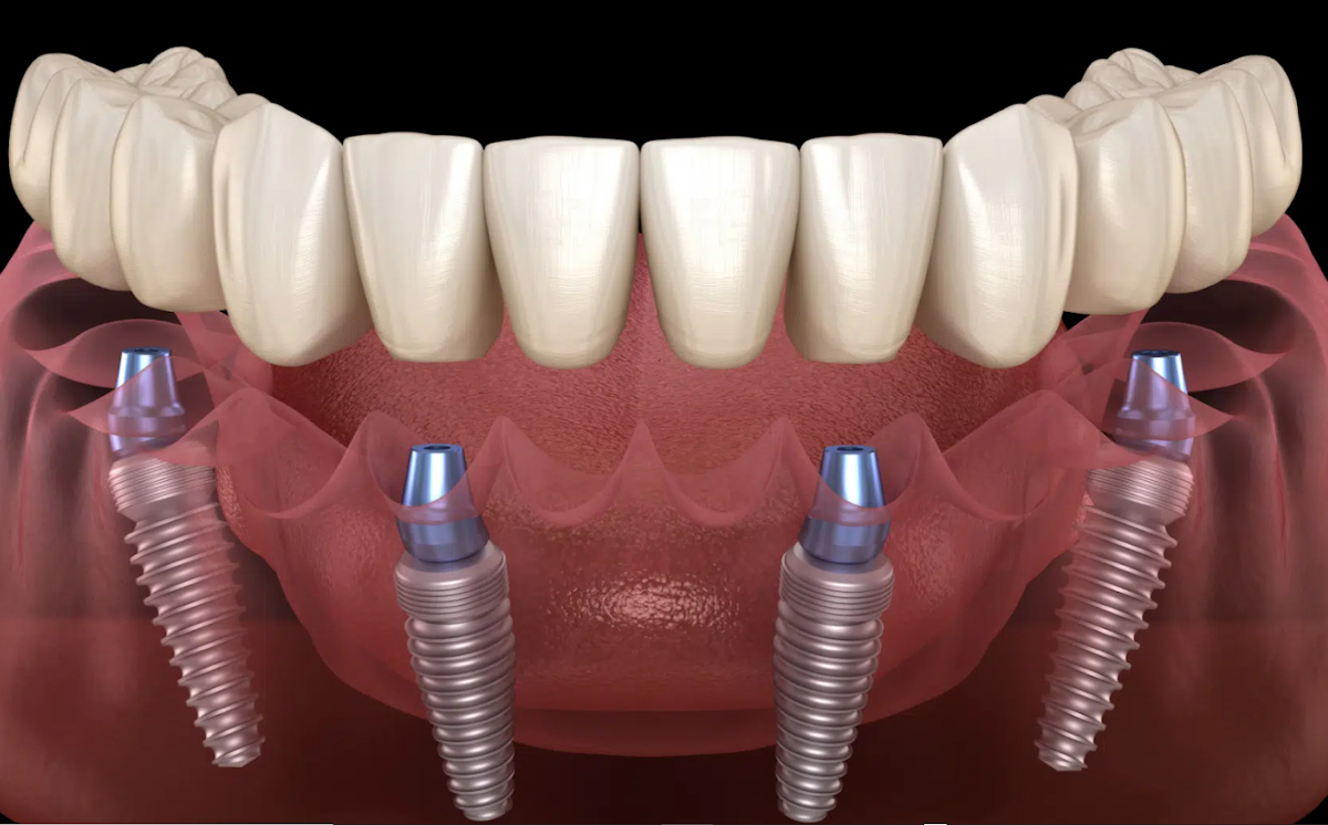 Implants dentaires All-on-4