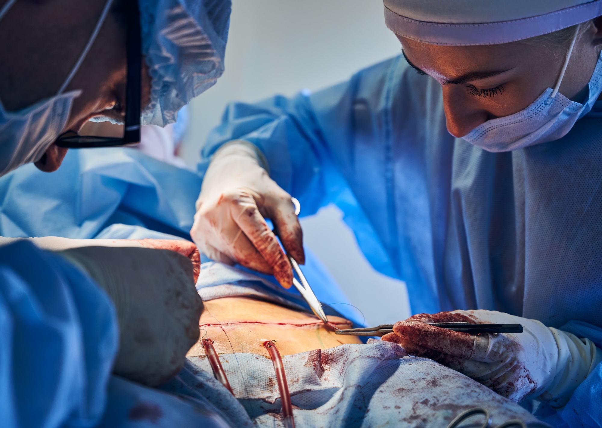 Doctor an assistant placing sutures following an abdominoplasty surgery.