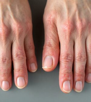 découvrez des témoignages authentiques sur les réussites et les échecs des traitements contre le psoriasis des ongles, pour mieux comprendre cette maladie et ses solutions.